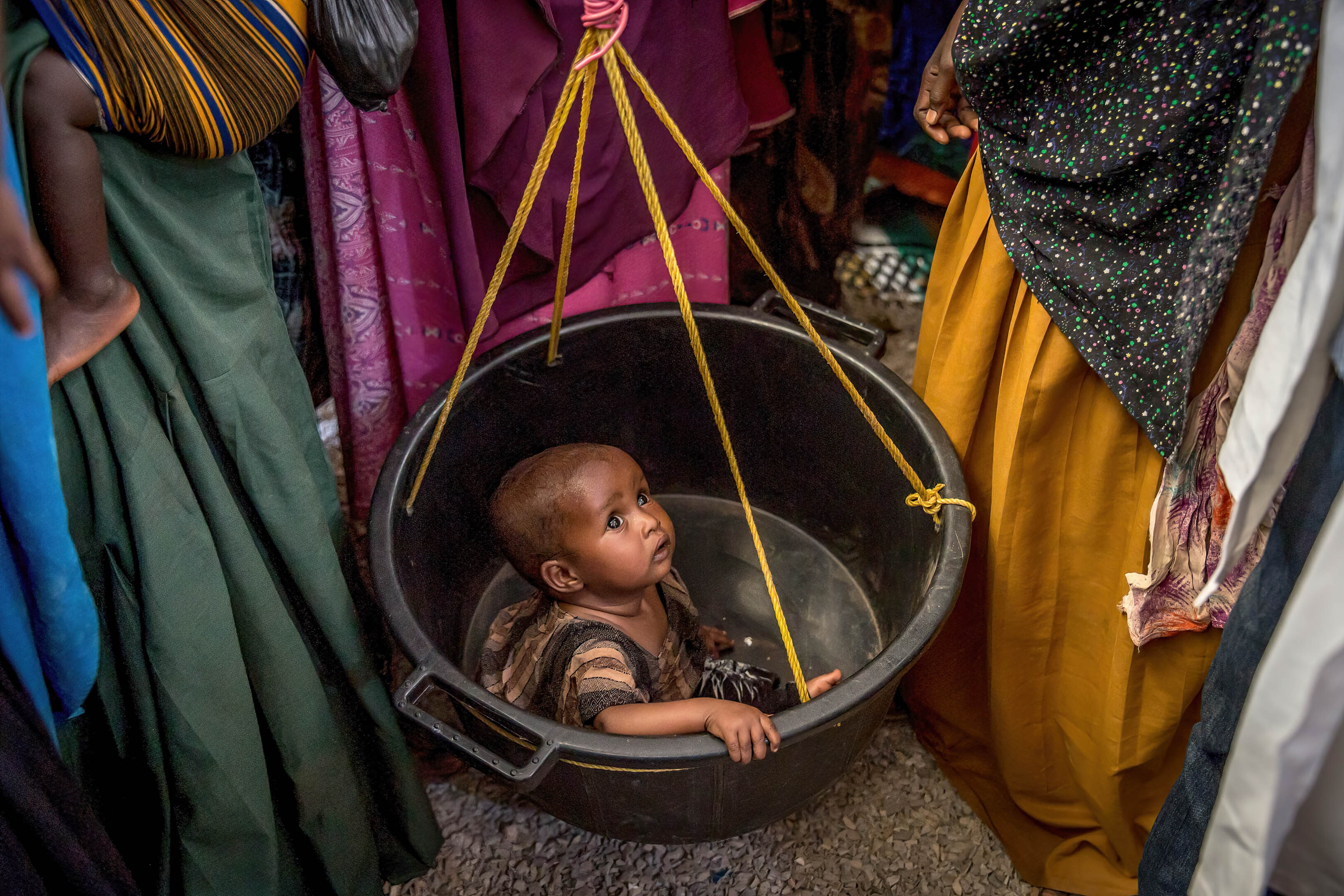 A child is screened for malnutrition at a health clinic in Baidoa, Somalia, where drought and other conditions have sparked concerns about famine.